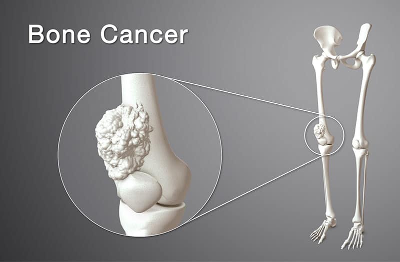 ung thư xương là gì